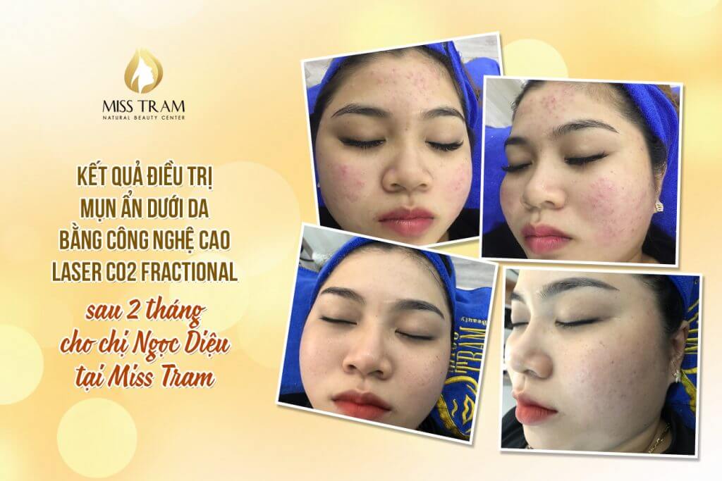 Results After 2 Months of Fractional CO2 Laser Treatment for Acne Hidden Under the Skin for Ms. Ngoc Dieu Special