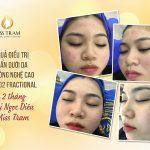 Kết Quả Sau 2 Tháng Điều Trị Mụn Ẩn Dưới Da Bằng Laser CO2 Fractional Cho Chị Ngọc Diệu Nghiên cứu