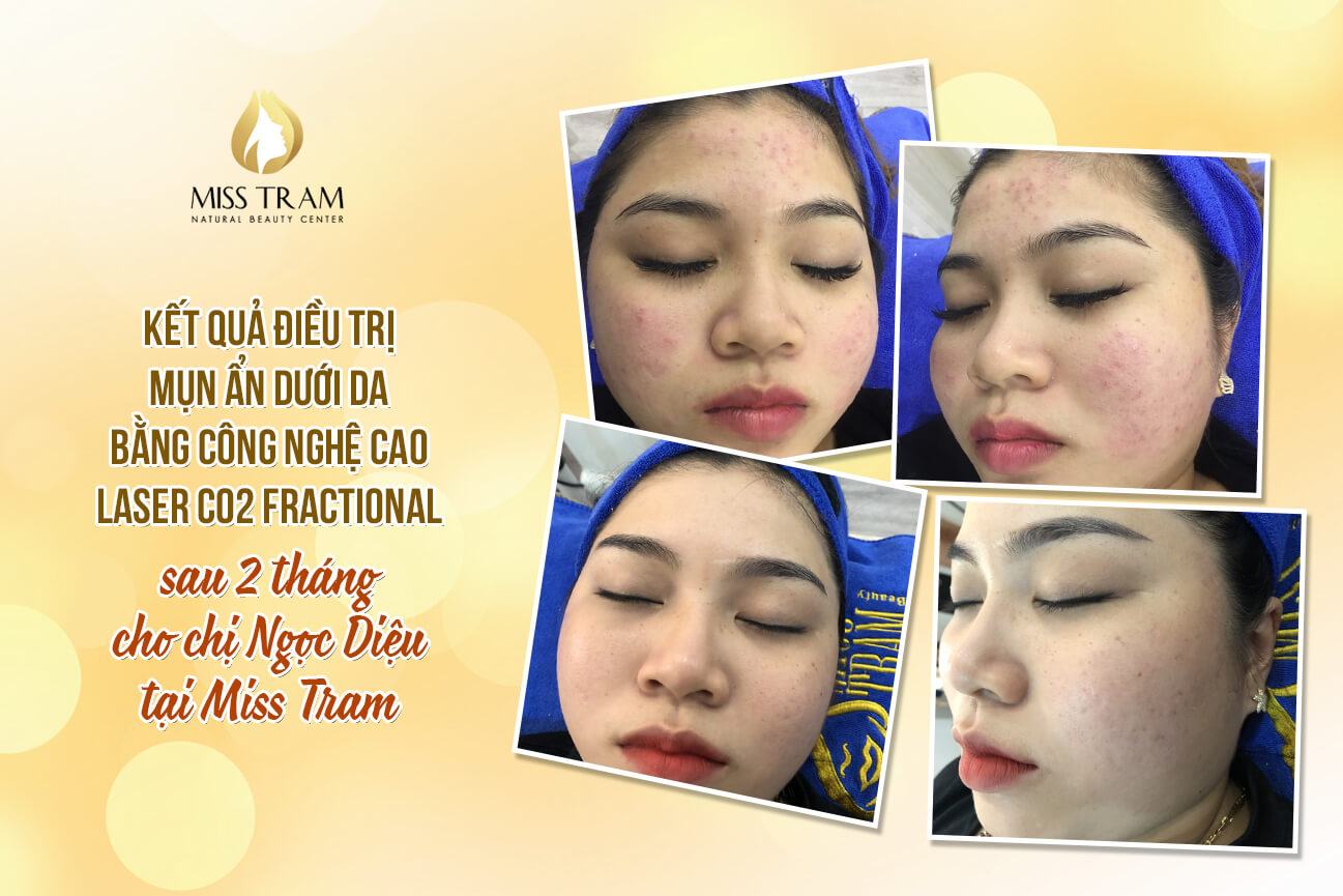 Results After 2 Months of Fractional CO2 Laser Treatment for Acne Hidden Under the Skin for Ms. Ngoc Dieu Discovered