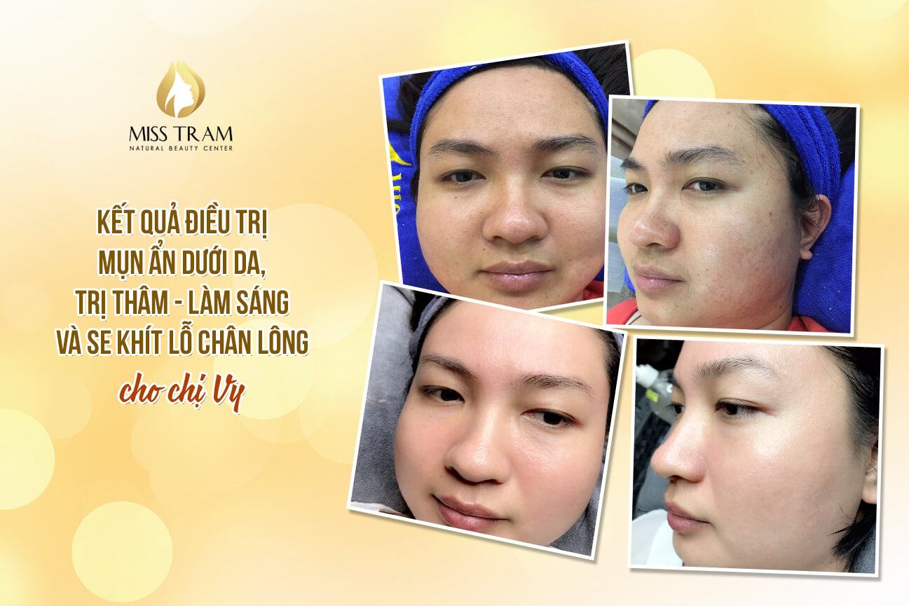 Results of Treatment of Acne Hidden Under the Skin, Treatment of Dark Spots, Tightening Pores For Ms. Vy Acknowledged