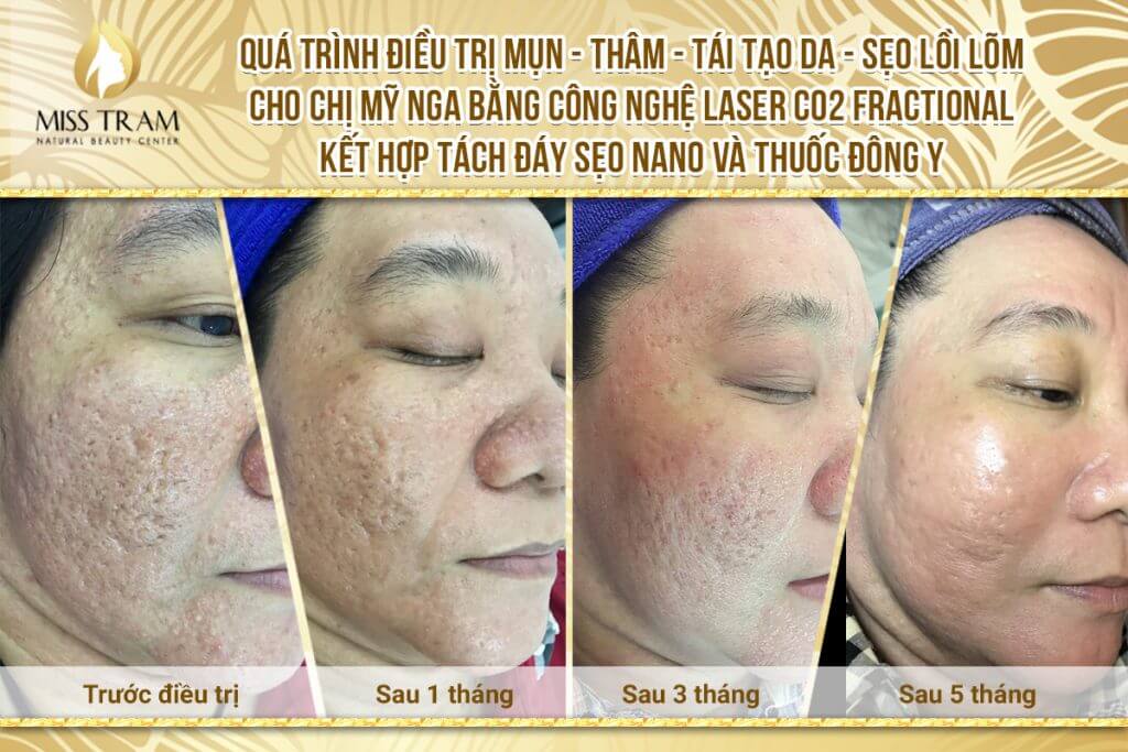 Acne Scar Treatment, Skin Regeneration by Fractional CO2 Laser Technology Combined with Oriental Medicine & Nano Scar Bottom Separation Consulting