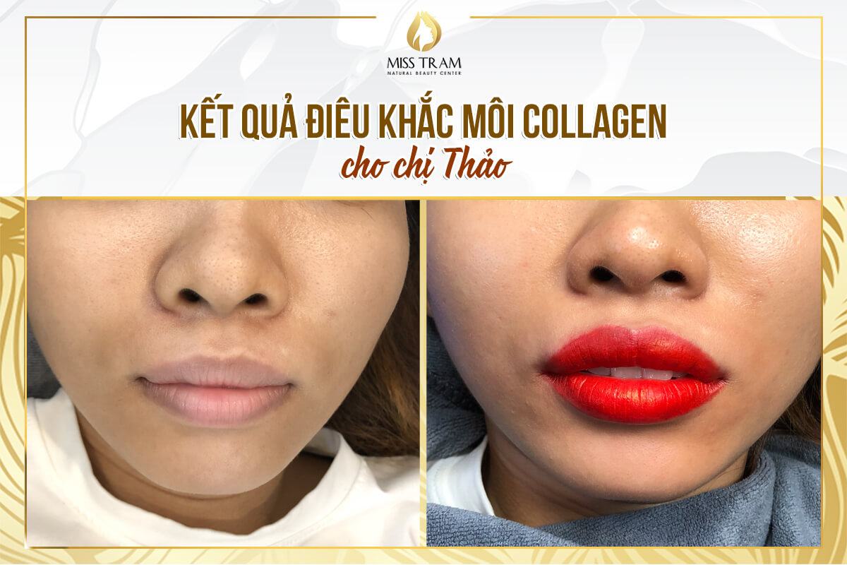 Results of Deep Treatment And Collagen Lip Sculpting For Ms. Thao Reflected