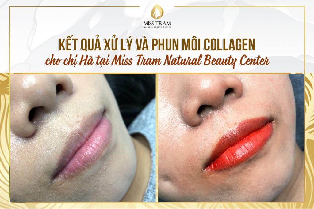 Results of Treatment And Collagen Lip Spray For Ms. Ha Directly