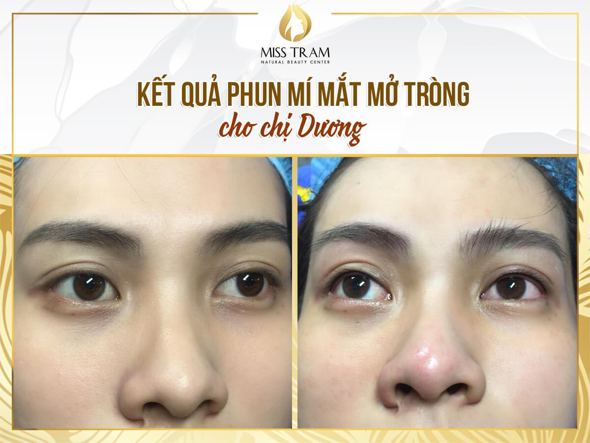 Results of Basic Eyelid Spraying Technology for Ms. Duong