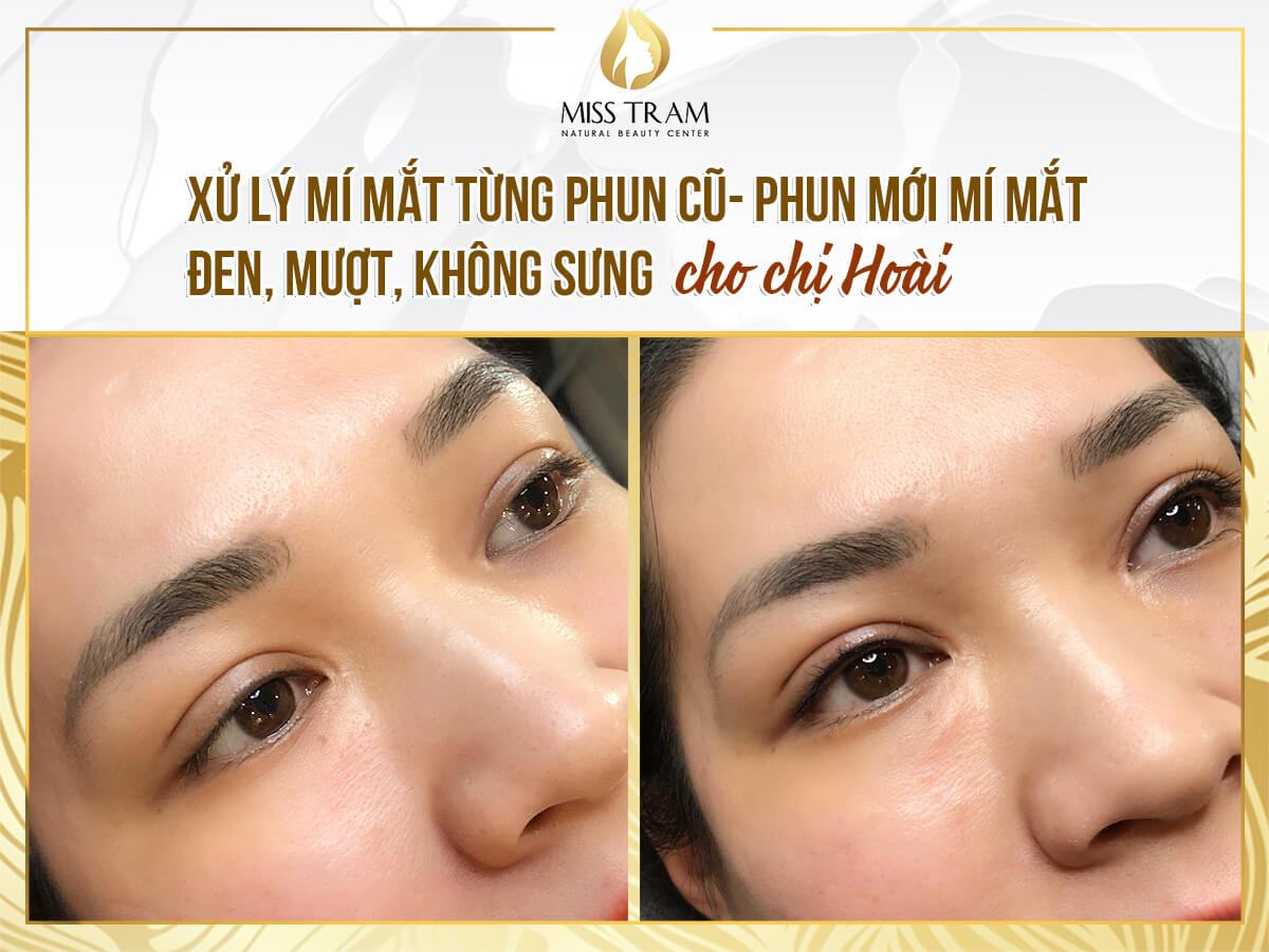 Treating Old Eyelids Ever Sprayed - Spraying Smooth, Painless Black Eyelids For Sister Hoai Basic
