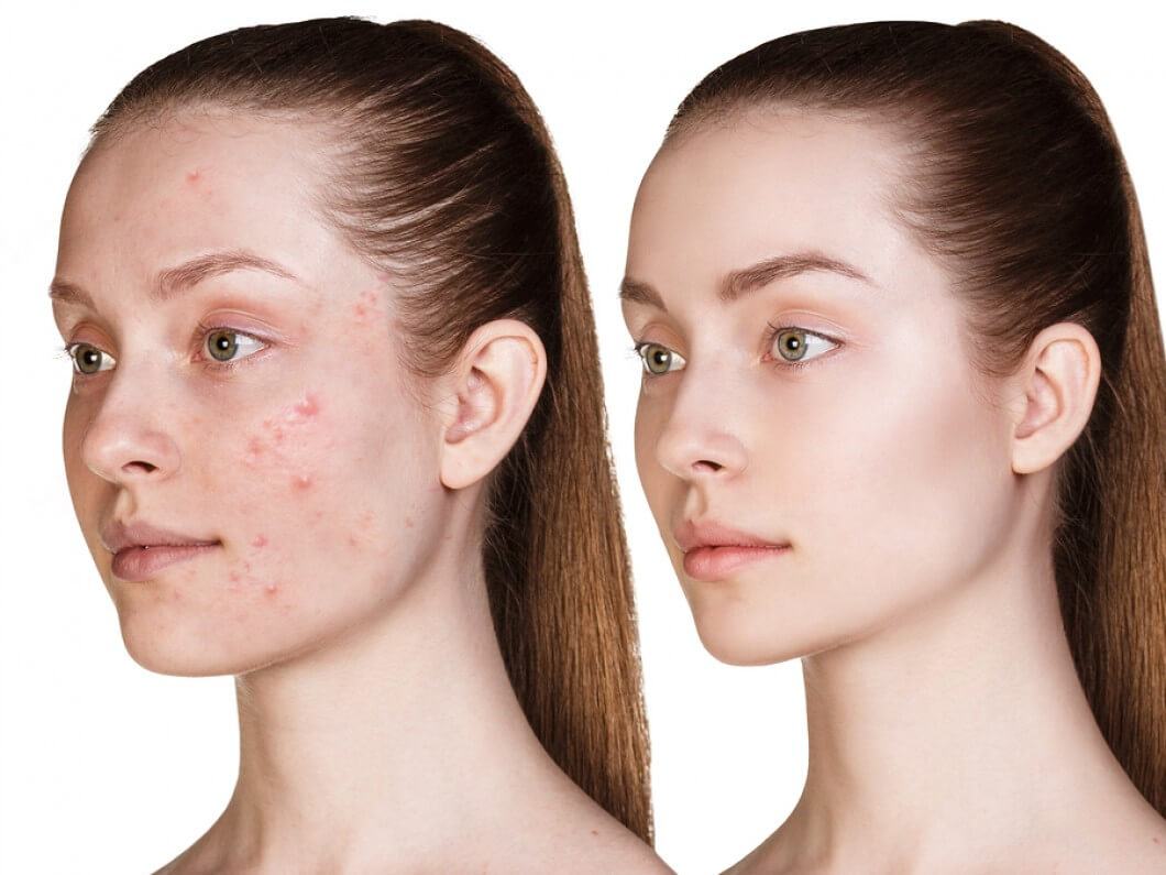 Treat Acne With Oxy Jet Technology Directly