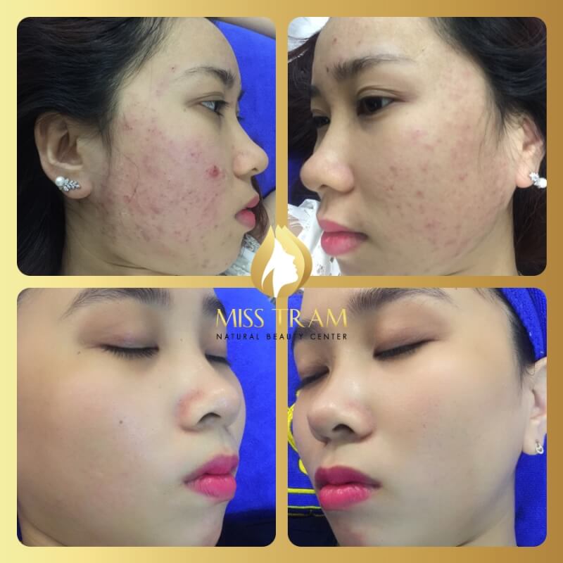 Acne treatment results with Nano Skin Technology