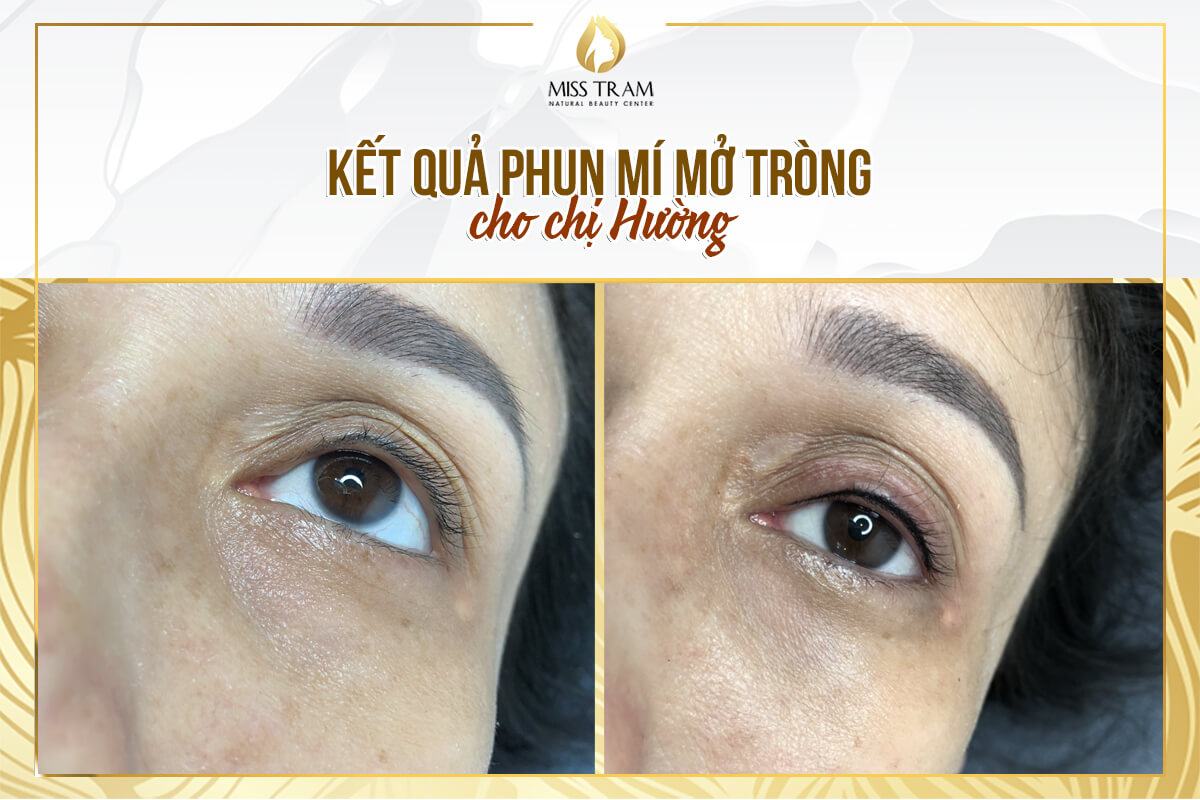 Results of Direct Eyelid Spraying Technology for Ms. Huong