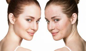 Acne Treatment With Bio Light Technology Need to know