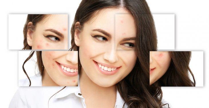Điều Trị Mụn Bằng Công nghệ Nano Skin Có Thật Sự Tốt?