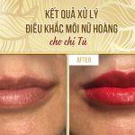 Kết Quả Xử Lý & Điêu Khắc Môi Nữ Hoàng Cho Chị Tú Nghiên cứu