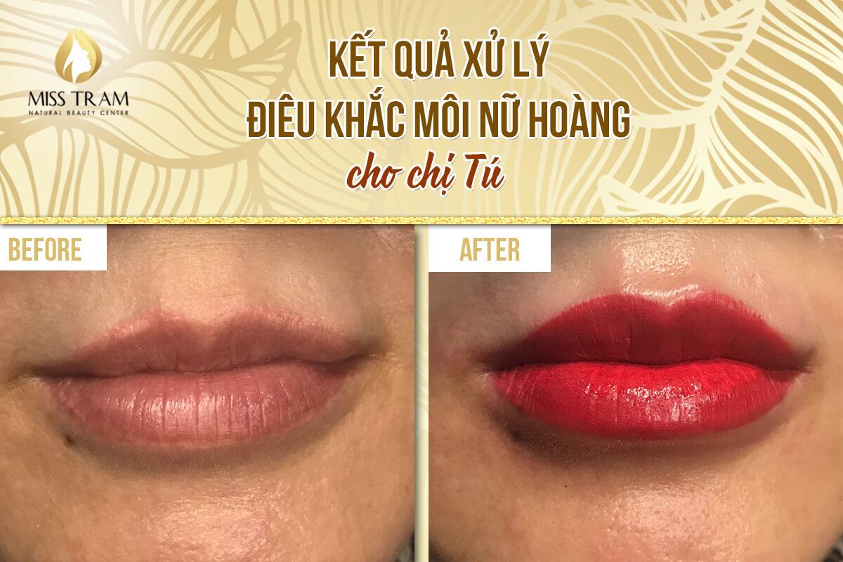 Queen's Lip Treatment & Sculpting Results for Sister Tu Basic