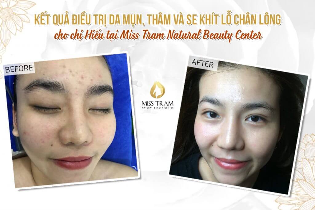 Clear Acne & Tighten Pores After 1 CO2 Laser Fractional Rule
