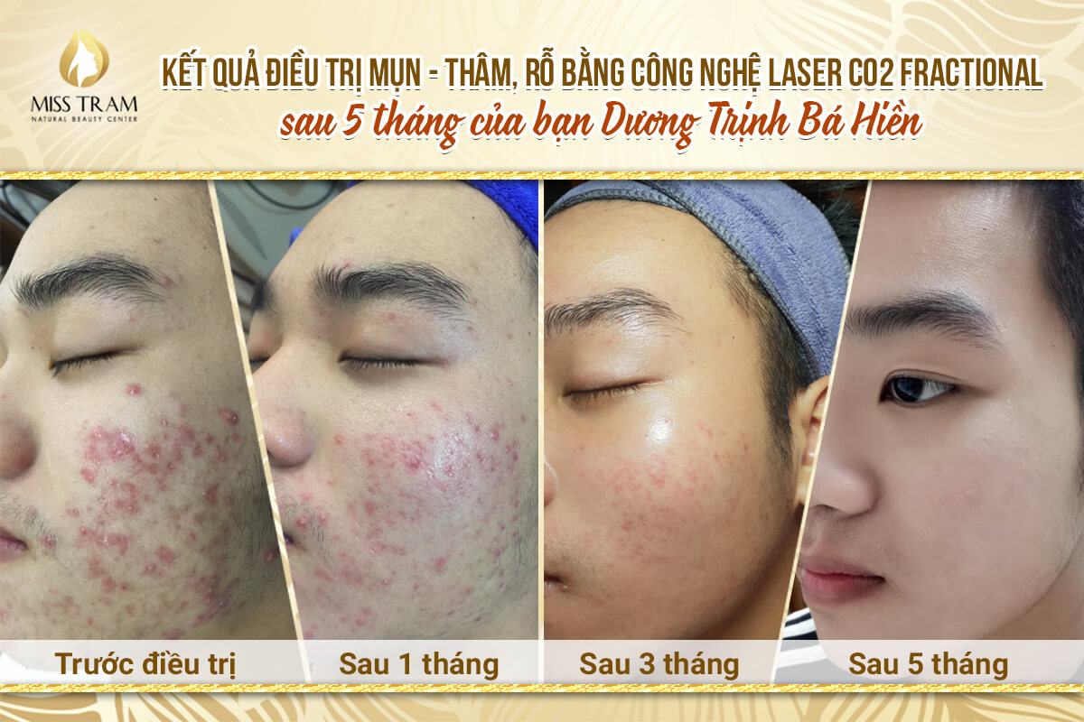 Result of Anh Hien's Acne and Pimples Treatment After 5 Months Rules