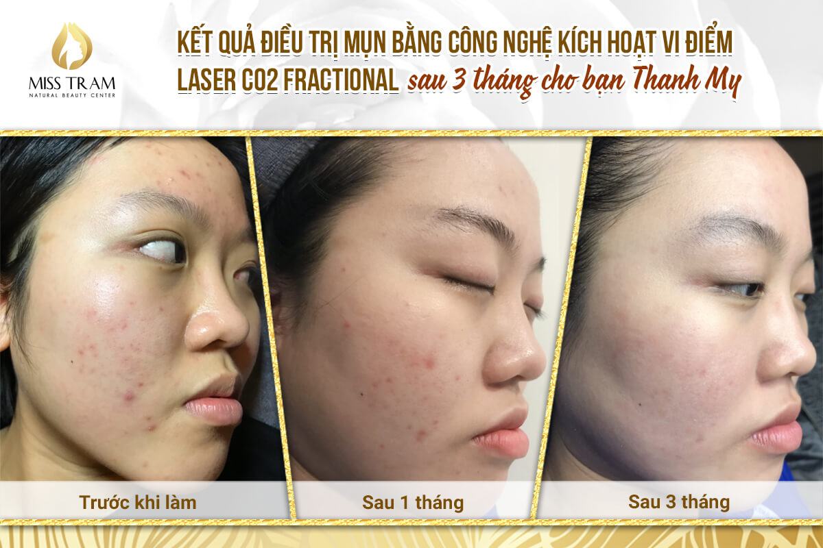 Acne Treatment With Fractional CO2 Laser Micro-Activation Technology After 3 Months Giving You Thanh My Ideas
