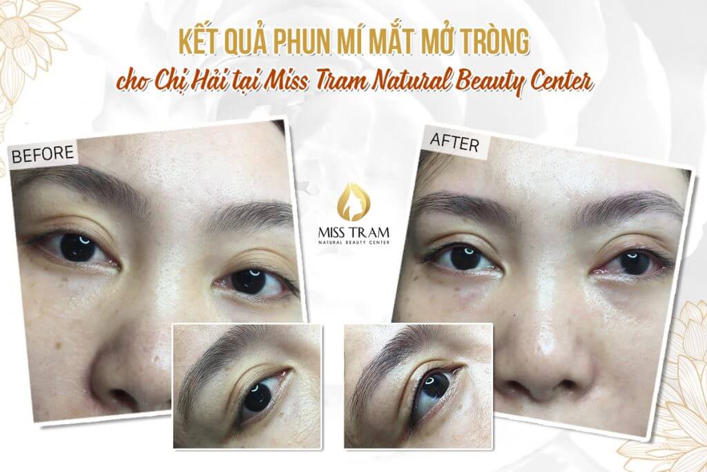 Results of Spraying Eyelids Open Natural Beauty For Ms. Hai Directly
