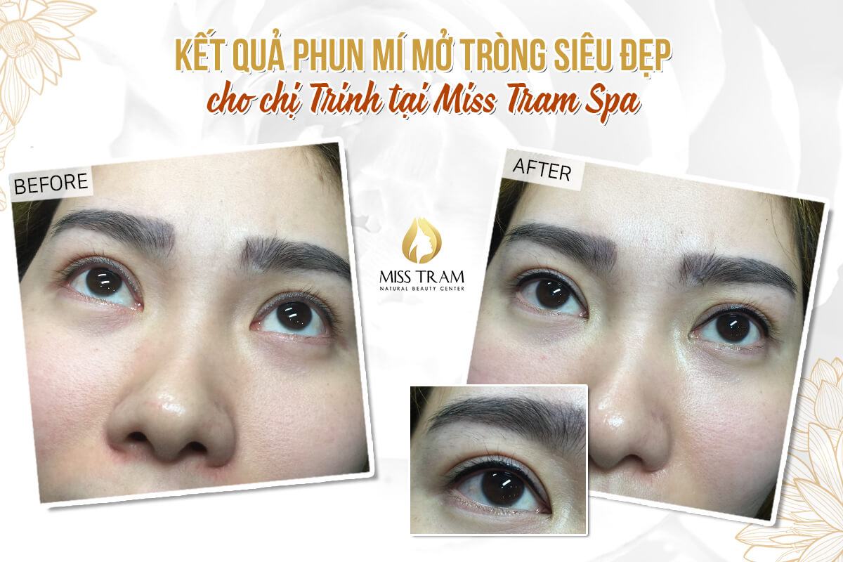 Beautiful Pictures Result of Eyelid Spraying for Sister Trinh's Perspective