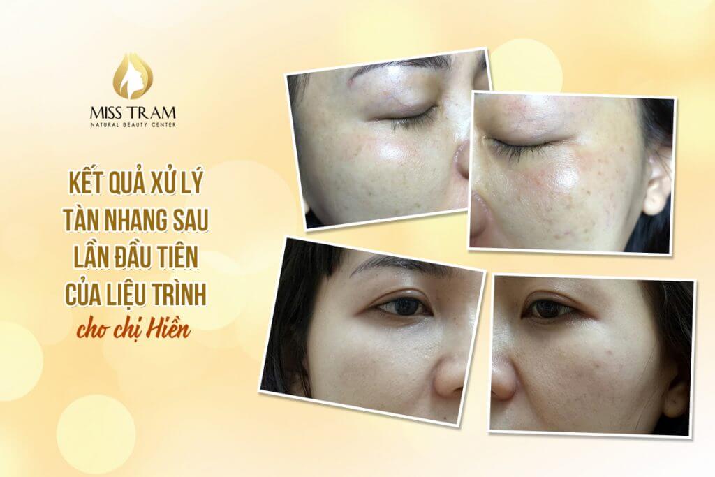 Freckles Treatment Results For Sister Hien Right After The First Time Of The Full Course
