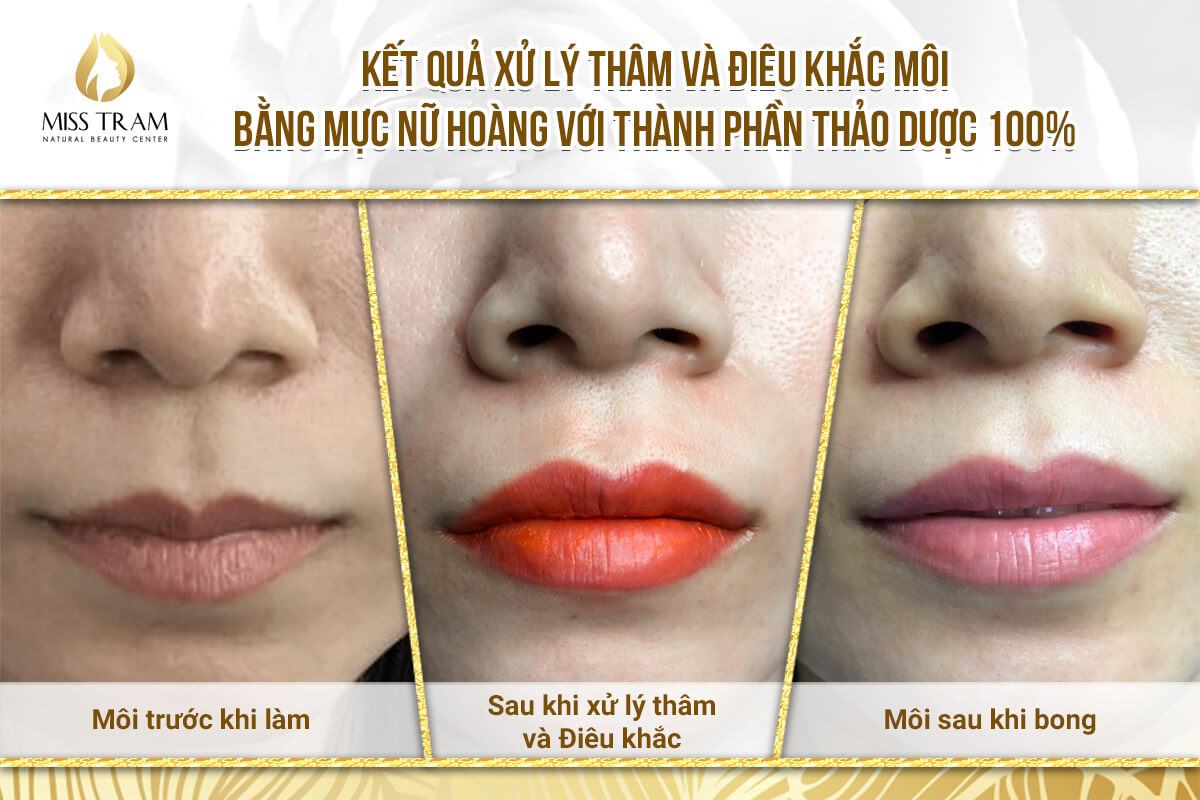 Results of Darkening & Sculpting Queen's Lips For Ms. Hoang Oanh Open Eyes