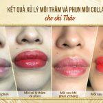 Kết Quả Xử Lý Thâm Và Phun Môi Collagen Cho Chị Thảo Tại Miss Tram Spa Nghiên cứu