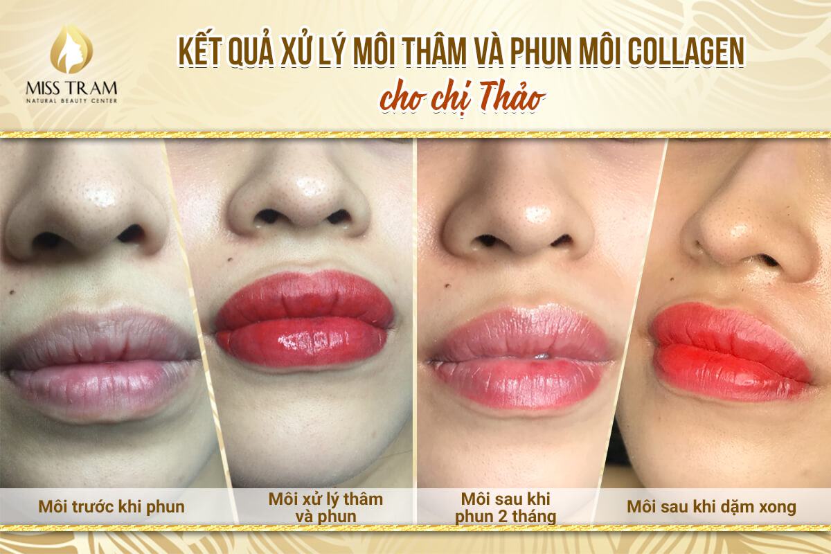 Results of Deep Treatment And Collagen Lip Spray For Ms Thao At Miss Tram Spa Accurate