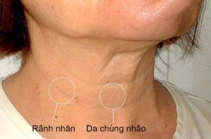 Wrinkled neck skin