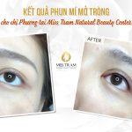 Kết Quả Làm Đẹp Bằng Phun Mí Mở Tròng Cho Chị Phượng Nghiên cứu