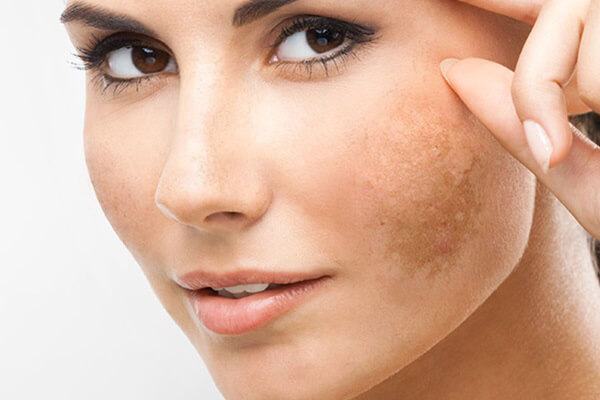 Revealing the Recovery Secret for Melasma Skin Possibilities