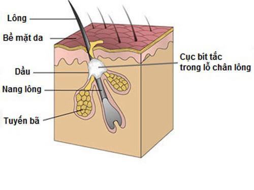 Nguyên nhân dẫn đến lỗ chân lông to