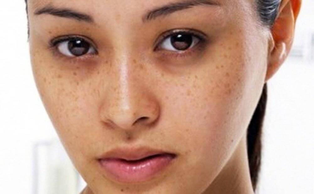 Uneven skin color can cause melasma, freckles