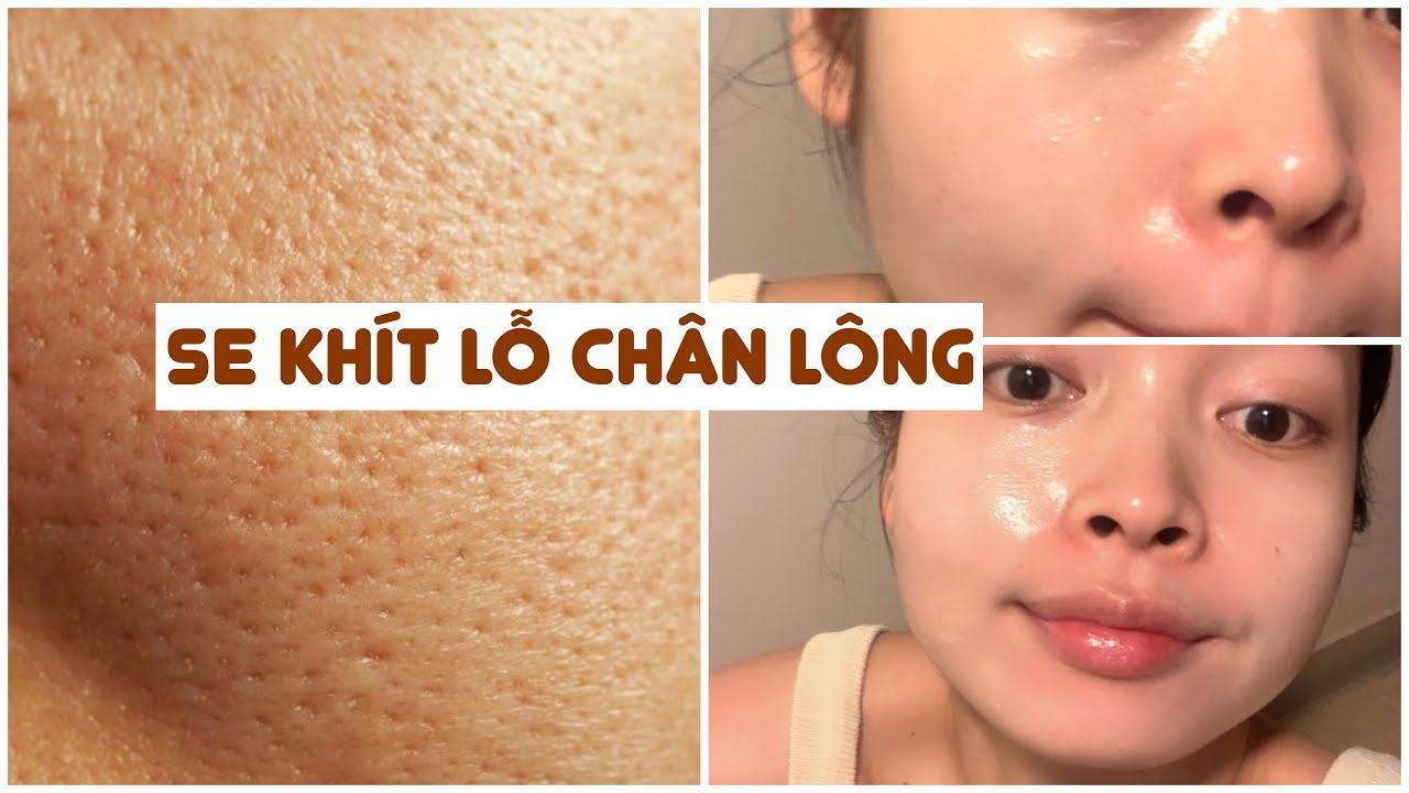 Tighten pores for acne-prone skin