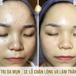 Điều Trị Da Mụn - Se Khít Lỗ Chân Lông Và Làm Trắng Da Cho Bạn Thuỳ Dương Nghiên cứu