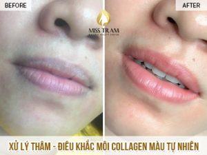 Kết Quả Sau Lần Đầu Xử Lý Thâm Và Điêu Khắc Môi Collagen Cho Chị Uyên Tin tức