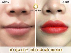 Xử Lý Và Điêu Khắc Môi Collagen Cho Bạn Trúc Tin tức