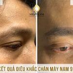 Kết Quả Điêu Khắc Chân Mày Nam Cho Anh Lộc Nghiên cứu