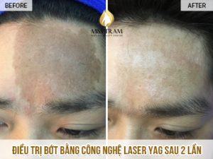 Kết Quả Xoá Vết Bớt Sau 2 Lần Cho Anh Mạnh Bằng Công Nghệ Laser Yag Tin tức