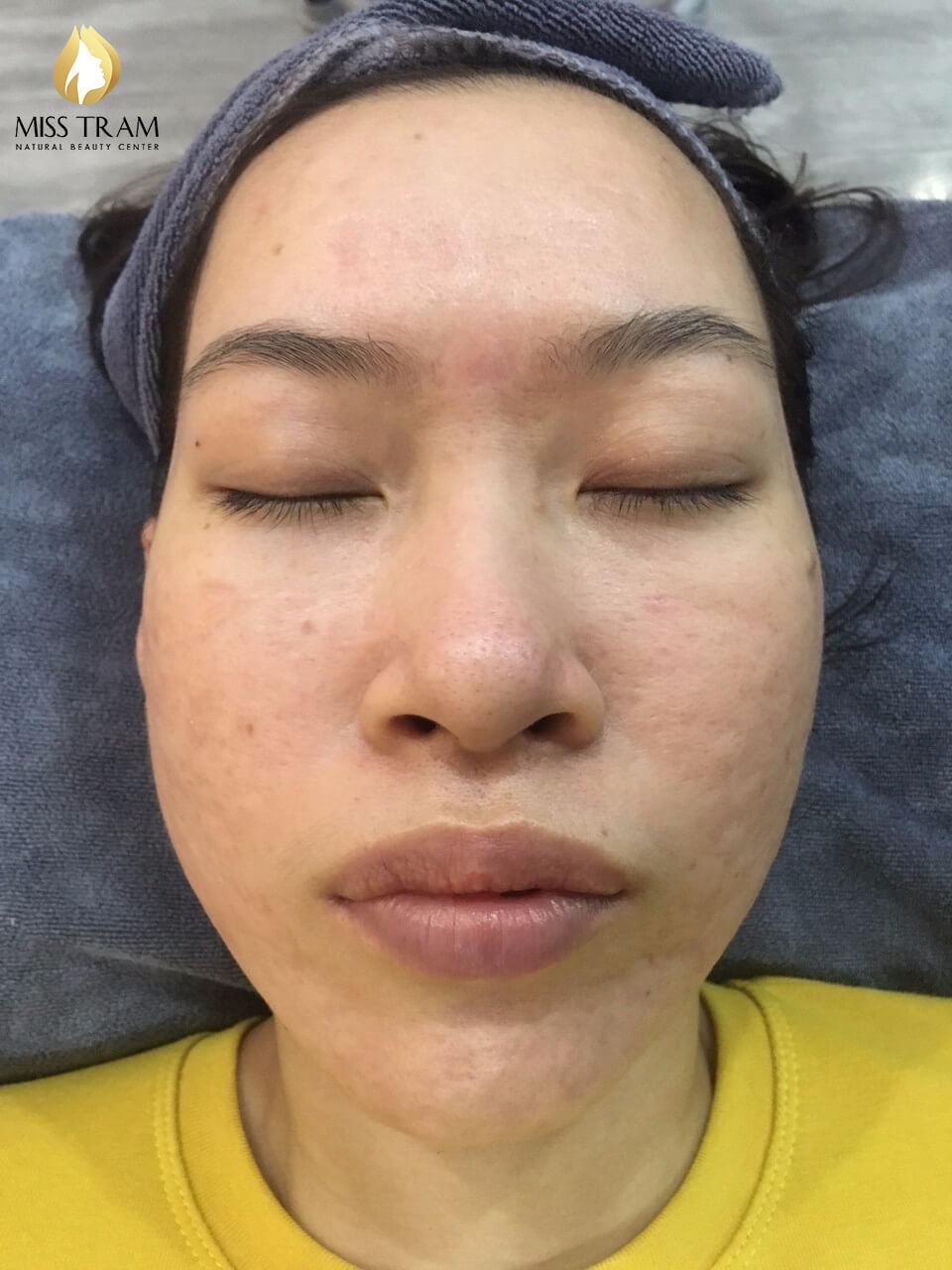 Milk Of Magnesia Acne: Acne Treatment Huong Beauty