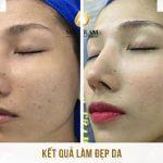 Cải Thiện Độ Sáng Và Làm Đẹp Da Cho Chị Quỳnh Nhi Tại Miss Tram Nghiên cứu