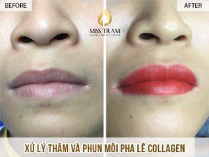 Kết Quả Xử Lý Thâm Và Phun Môi Collagen Cho Chị Mai Tin tức