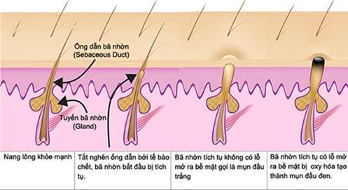 giai đoạn hình thành mụn đầu đen