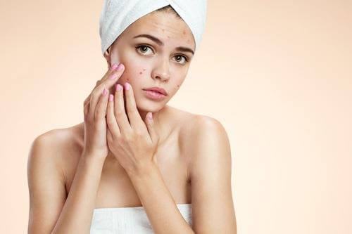 Top 8 Foods That Can Cause Acne You Need To Know The Truth