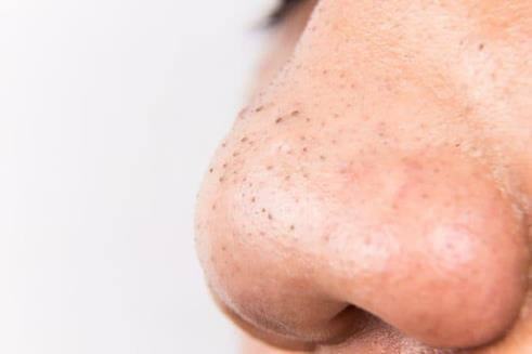 How to remove blackheads effectively