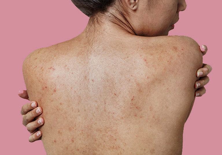 What causes back acne?