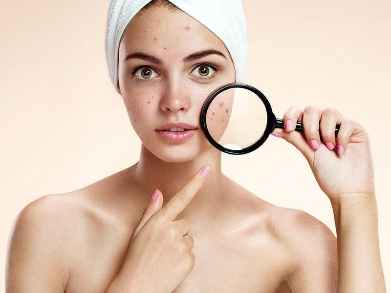 Why does acne treatment not go away?