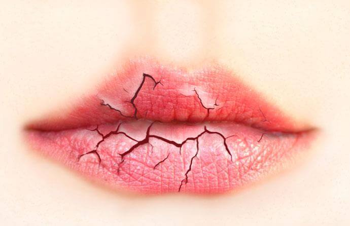 Causes of dry lips