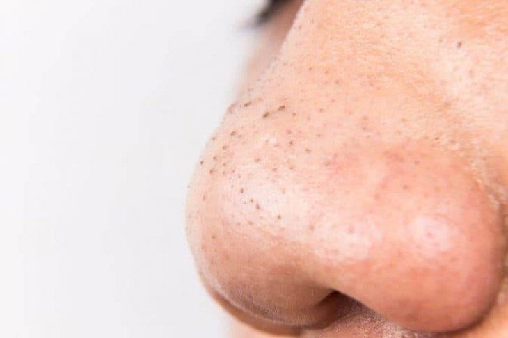 Trị Mụn Đầu Đen Hiệu Quả Với Mặt Nạ Đất Sét