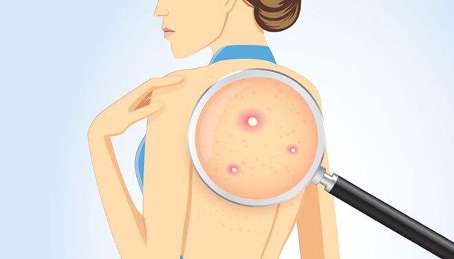 Why You Can't Get Rid Of Back Acne? Detail