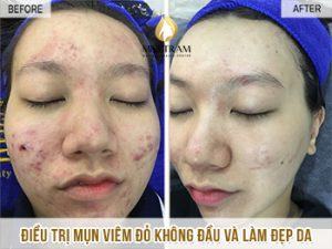 Treatment of Inflammatory Red Acne No Head And Skin Beauty For Baby Minh Ngoc Finally