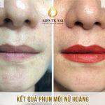 Xử Lý Thâm Lem Và Phun Môi Nữ Hoàng Cho Chị Châu Nghiên cứu