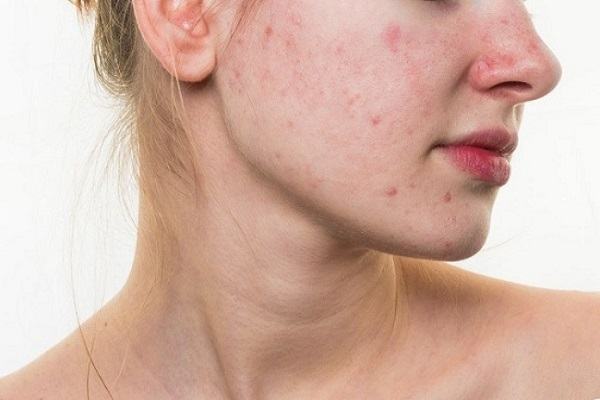 Skin care for itchy, acne-prone skin